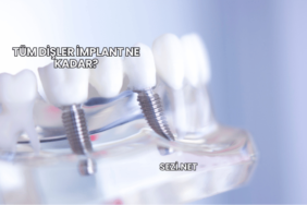 Tüm Dişler İmplant Ne Kadar?